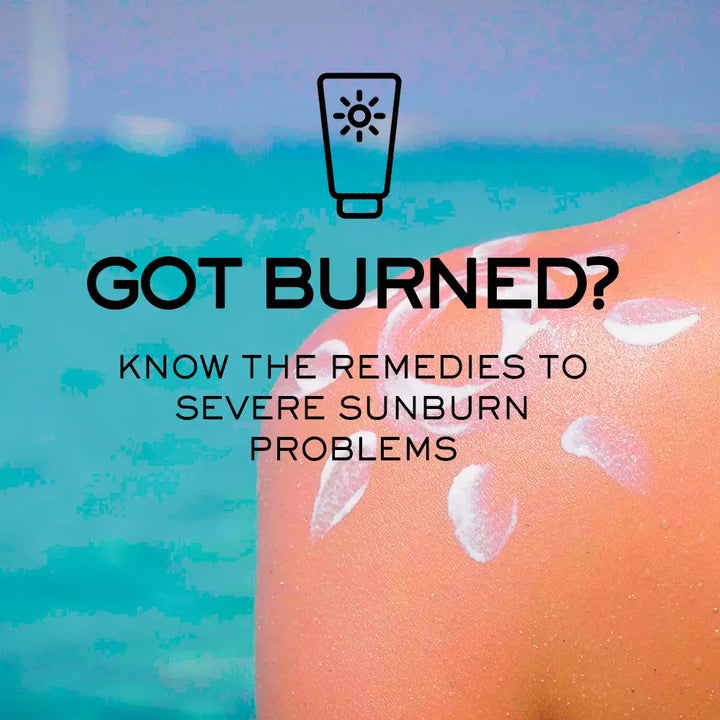 GOT BURNED? KNOW THE REMEDIES TO SEVERE SUNBURN PROBLEMS