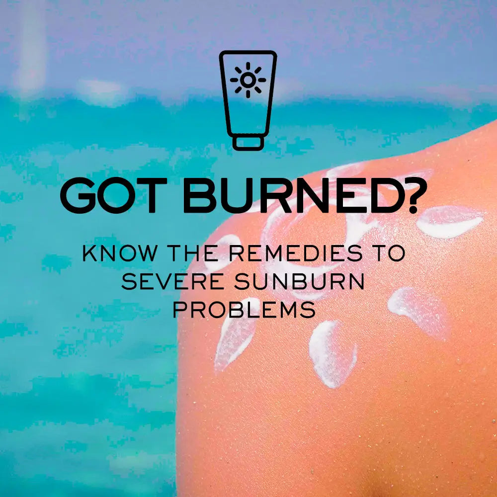 GOT BURNED? KNOW THE REMEDIES TO SEVERE SUNBURN PROBLEMS